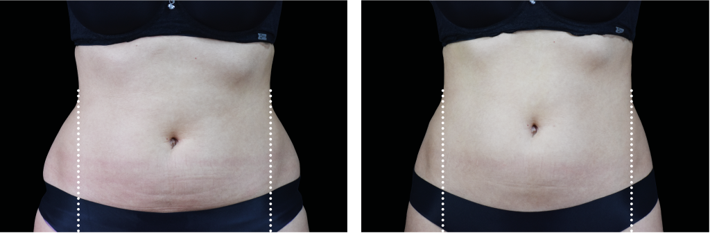 Before and after of Non-Surgical Body Contouring